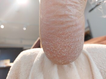 爪切り屋 足楽/ウロコ踵