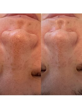 モア 吉祥寺(MORE.)/毛穴洗浄Before after