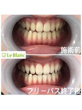 ルブラン 奈良店(Le Blanc)/高校生もホワイトニング！！