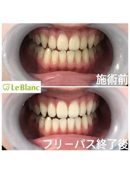 ルブラン 奈良店(Le Blanc)/高校生もホワイトニング!!
