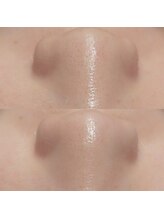 マイフェアレディ 今池(MyFairLady)/毛穴洗浄☆ハイドロフェイシャル