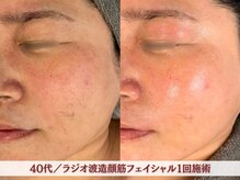 アリィ エステティック(allie esthetic)/【造顔筋ラジオ波フェイシャル】