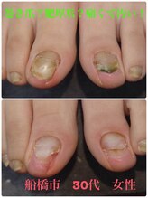 巻き爪じゅん 船橋店/巻き爪？肥厚爪？爪が痛くて汚い
