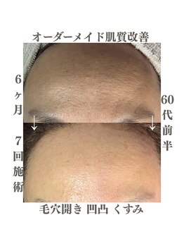 レイ(Rey)/凸凹毛穴開き、くすみ改善