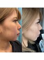 アイアム(I am) 小顔ハイリフトで実際私が変化を体感してます!オススメです!