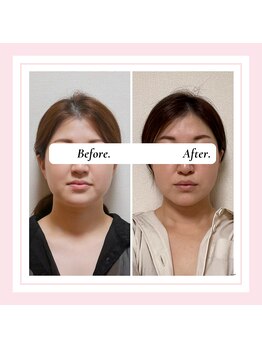 ル フラーズ(Les Fleurs)/小顔矯正 むくみ