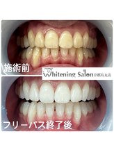 ホワイトニングサロン 京都烏丸店/ホワイトニング施術例