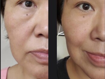 アイリー(IRIE)/サーマル