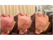 美肌ケアサロン iru 北千住店【ハーブピーリング | ララピール | 毛穴洗浄】/自社オリジナル製品のハーブ