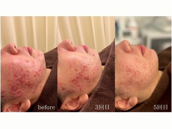 美肌ケアサロン iru 北千住店【ハーブピーリング | ララピール | 毛穴洗浄】/自社オリジナル製品のハーブ