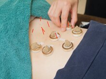 セントラルたなか鍼灸院 上社院/・鍼灸施術