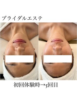 イム(I'm.)/ブライダル before/after