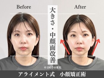 アライメントトウキョウ 恵比寿(Alignment TOKYO)/大きさ・中顔面