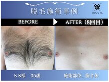 メンズビービー 福井高柳店(MEN'S BB)/ボディ脱毛施術事例