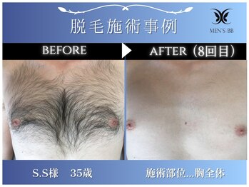 メンズビービー 福井高柳店(MEN'S BB)/ボディ脱毛施術事例