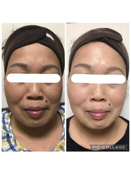 ヒマワリ 上板橋店(Himawari)の写真/秋冬の乾燥に負けない美肌ケア!幹細胞で毛穴やシミをケアして、もちもち肌へ♪