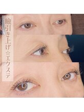 インディゴ(Indigo)/瞼を引き上げ