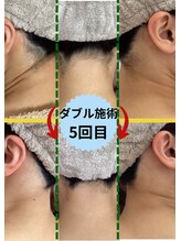 ディスイズミー シュガーリング(This is me Sugaring)/【ダブル】自己処理して失敗箇所