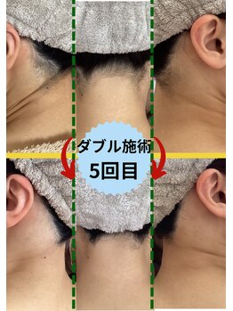 ディスイズミー シュガーリング(This is me Sugaring)/【ダブル】自己処理して失敗箇所