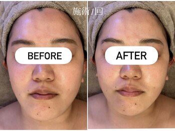 エービューティーサロン 松山店(A BEAUTY SALON.)/30代女性　顔むくみ改善
