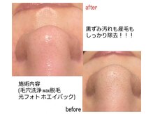 ウィズティ(with.T)/毛穴集中コース