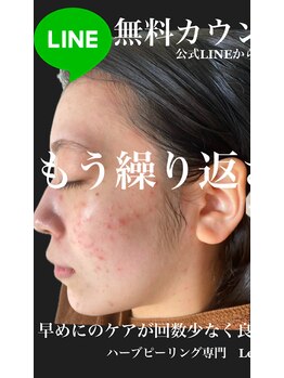 リベル 名古屋(Lebelle:)/ハーブピーリング専門名古屋