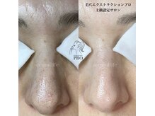 セカンドライフの雰囲気（毛穴エステ　ビフォーアフター）