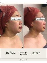 サンテボーテ(Sante Beaute)/レモンボトルコース　２回目