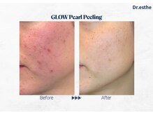 オーシャンブルー 福岡店(OCEAN BLUE フェイシャル&ボディ)/【韓国】グロウパールピーリング