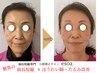 【 本格改善 】面長短縮×たるみリフト小顔矯正(60分)￥26000→￥13000