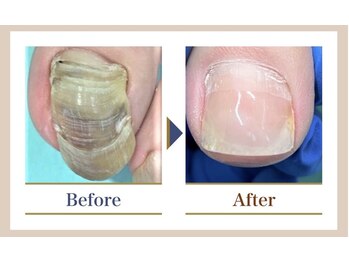 巻き爪補正店 越谷店/変形爪再生補正