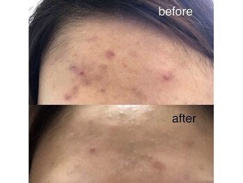 ララスマイル 鶴崎森町店/お肌改善プログラム(ニキビケア)