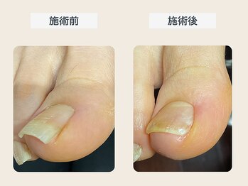 ルポ 伊勢/巻き爪ケア