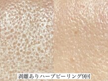 アリス(ALICE)/毛穴改善にはハーブピーリング