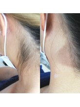 RiとBiのたまご/（速効脱毛）襟足、首脱毛　