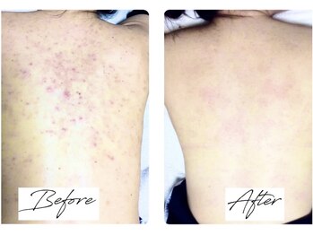 ビズビズ 梅田店(bisebise)/〈症例〉背中ニキビケア/赤み跡