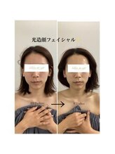 メディカルサロンドオフ 堺東店(medical salon de off)/光造顔フェイシャル★　施術前後