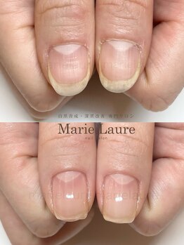 マリーロール 梅田店(Marie Laure)/深爪矯正/自爪育成/自爪風