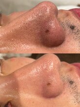 ラフ(LaFF)/毛穴洗浄Before＆After