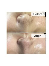 ル ボヌール 伊那店(le bonheur)/３回目で毛穴が小さく