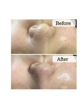 ル ボヌール 伊那店(le bonheur)/３回目で毛穴が小さく