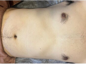 ヨハク(YOHAKU)/20代後半　男性　７回施術before