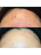 エラ(ella)/20代ニキビケア