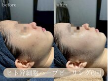 ハジュ(HAJU.)/繰り返すニキビも改善