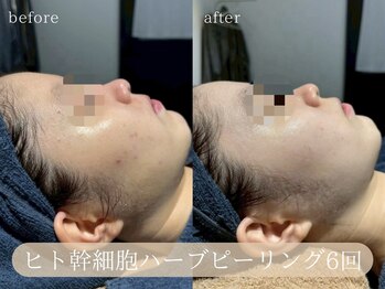 ハジュ(HAJU.)/繰り返すニキビも改善