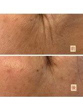 ハズキ(HAZUKI)/笑わなくても目立つ深い目のしわ