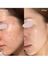 ミーラヤ(MILAYA)/梅田毛穴/梅田リアボーテ