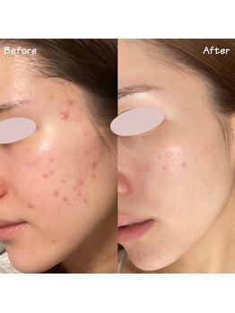 ミーラヤ(MILAYA)/梅田毛穴/梅田リアボーテ