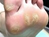 【タコ・魚の目・角質】３０分一律価格+【足の爪切りセット】¥7,150→¥5,500
