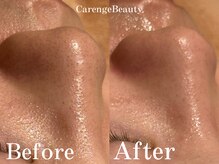 カレンジェビューティー(CarengeBeauty)/ハイドラ水光ピーリング